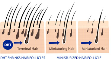 Andogenetic Alopecia - Female Hair Loss