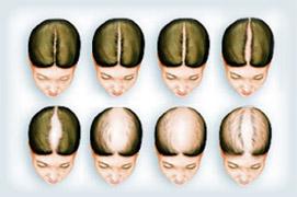 Female Pattern - Female Hair Loss
