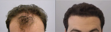 Results1 - Male Hair Loss