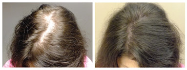 femal Results - Female Hair Loss
