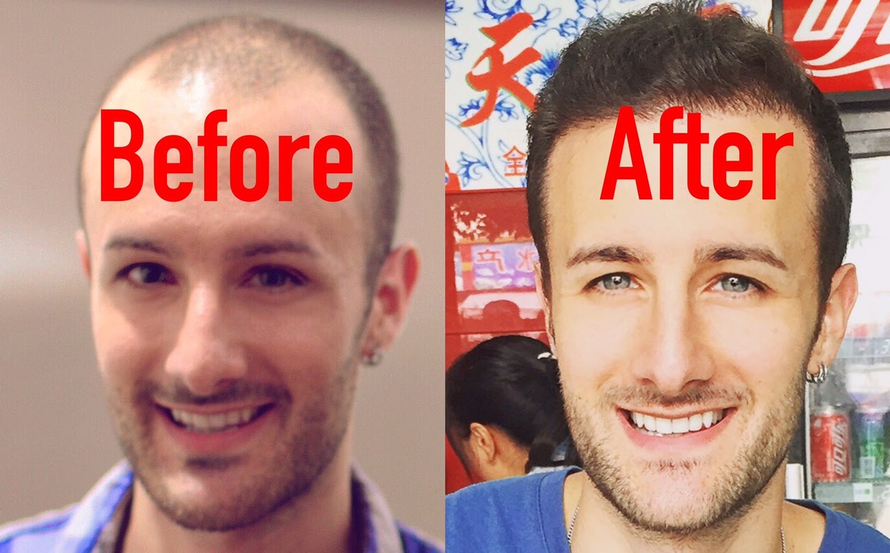Hair Transplant in Chandigarh 4 - How To Choose A Good Hair Transplant Doctor In Chandigarh?