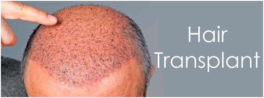 hair transplant Athena 2 - What To Consider For A Hair Transplant In Chandigarh?